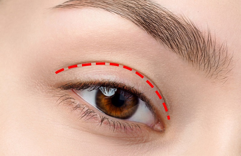 Quy trình cắt mí mắt trên tại Hồng Ngọc