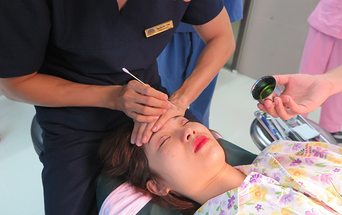 Cắt mí mắt trên là gì?