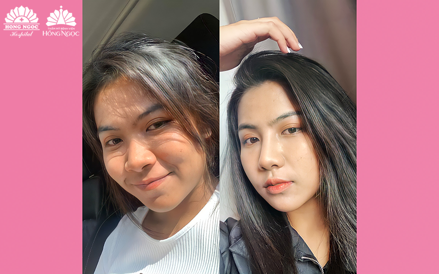 Nâng mũi bán cấu trúc là gì?