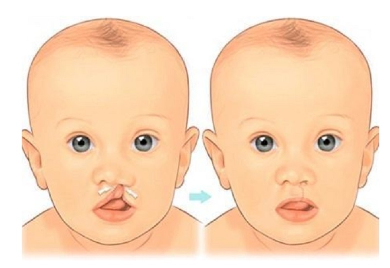 Quy trình phẫu thuật sứt môi tại Hồng Ngọc