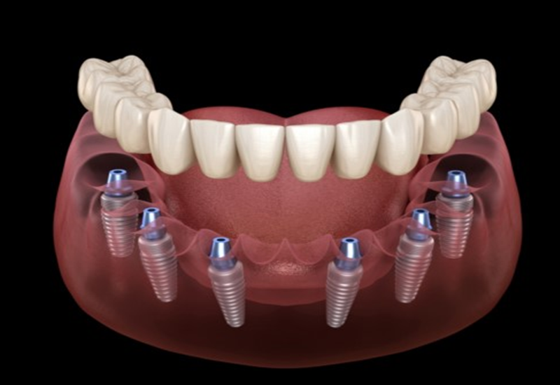 Trồng răng implant – Giải pháp phục hình răng mất tối ưu