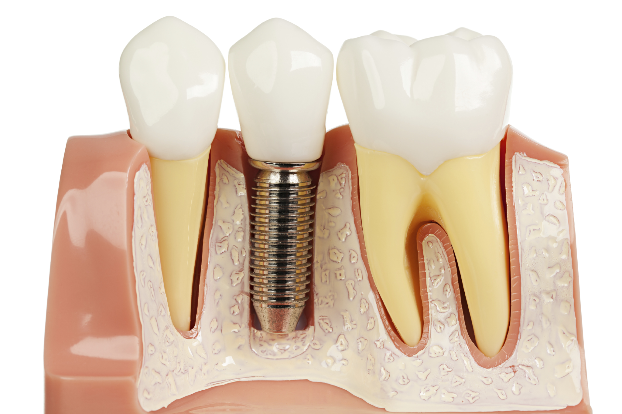 Trồng răng implant an toàn tại Bệnh viện Hồng Ngọc