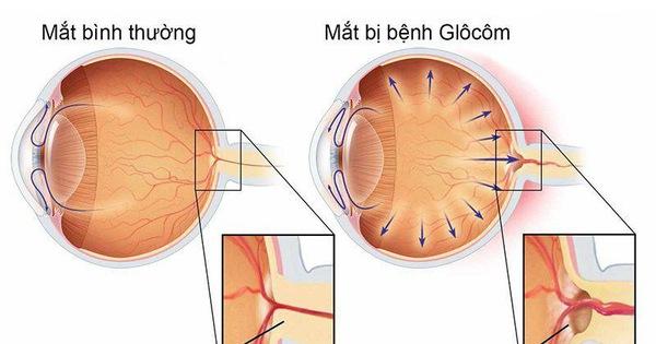 Phương pháp điều trị glaucoma
