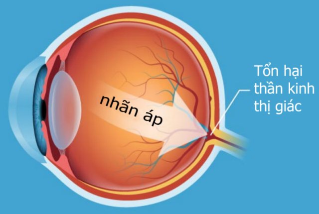 Glaucoma là gì?