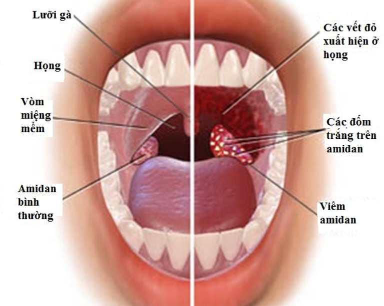 Cách điều trị viêm họng, viêm amidan