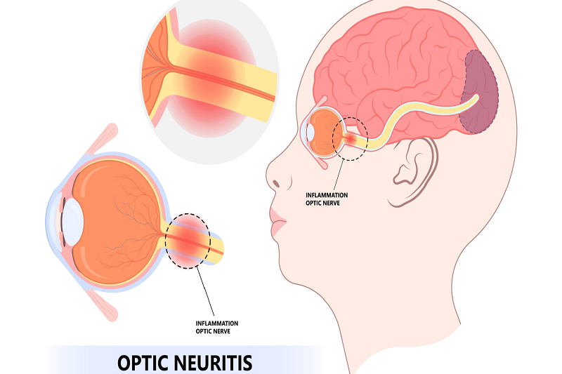 Tầm quan trọng của nội soi trong chẩn đoán và điều trị bệnh lý dạ dày