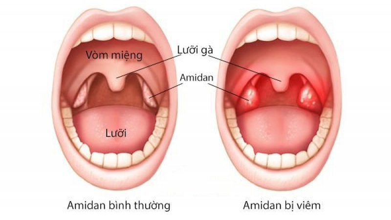 Tầm quan trọng của nội soi trong chẩn đoán và điều trị bệnh lý dạ dày