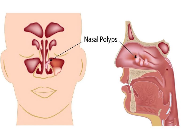 Polyp mũi là gì?