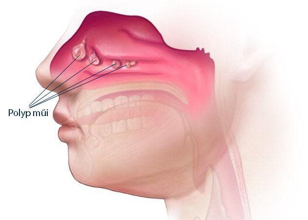 Phương pháp điều trị polyp mũi