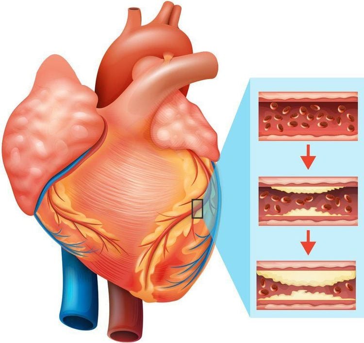 Cách xử lý và điều trị bệnh mạch vành
