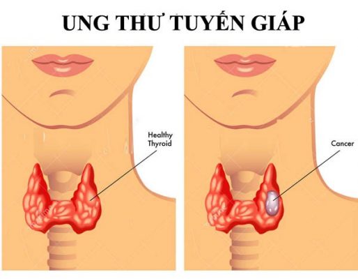 Chẩn đoán ung thư tuyến giáp