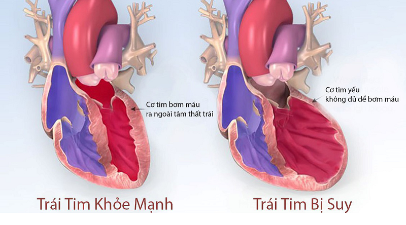 Biến chứng nguy hiểm của suy tim