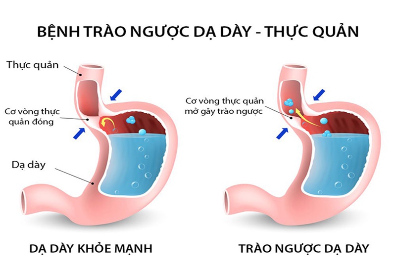 Tầm quan trọng của nội soi trong chẩn đoán và điều trị bệnh lý dạ dày