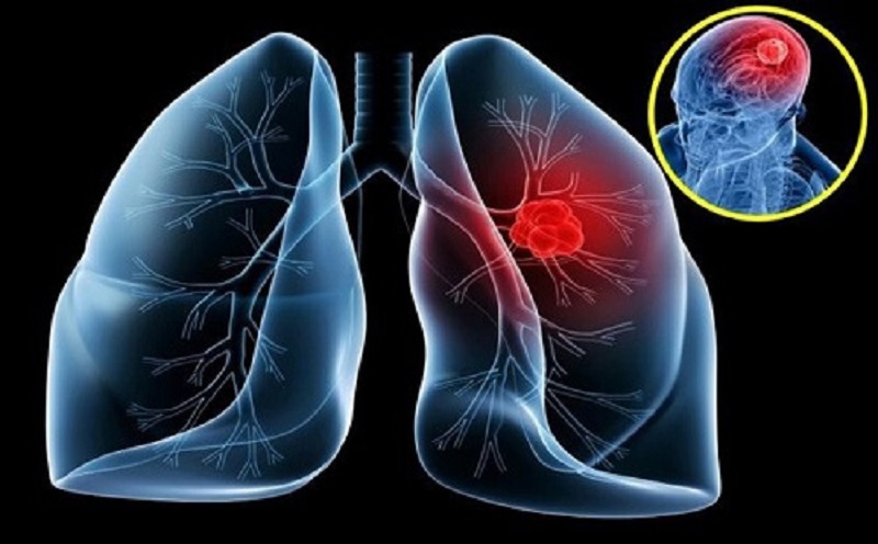 Tầm quan trọng của nội soi trong chẩn đoán và điều trị bệnh lý dạ dày