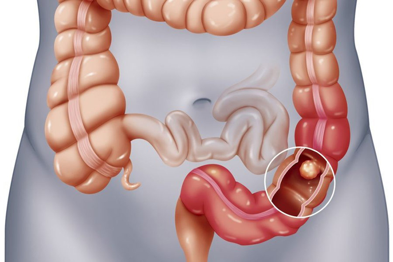 Tầm quan trọng của nội soi trong chẩn đoán và điều trị bệnh lý dạ dày