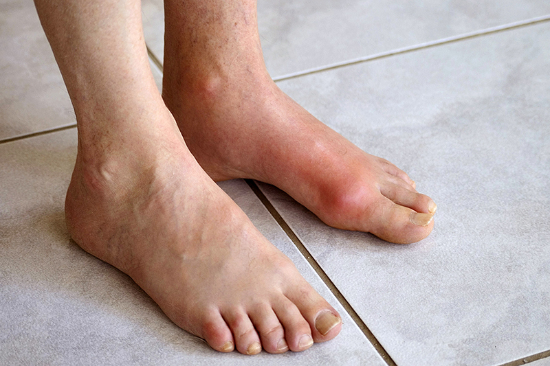 Bệnh gout là gì?