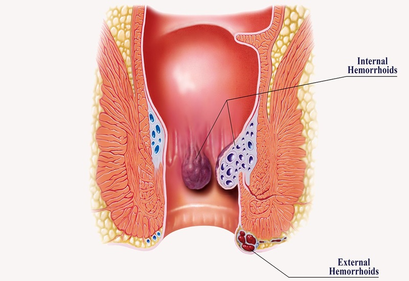 Phương pháp điều trị bệnh trĩ