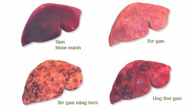 Ung thư gan – Biến chứng nguy hiểm nhất