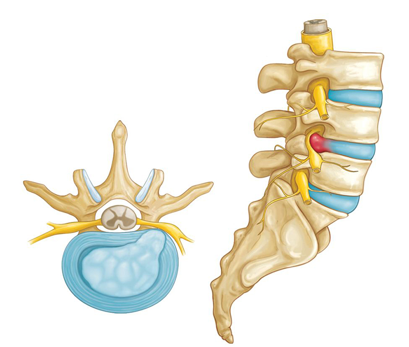 Thoát vị đĩa đệm là gì?