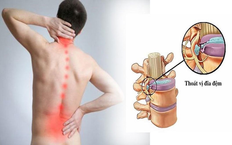 Điều trị thoát vị đĩa đệm