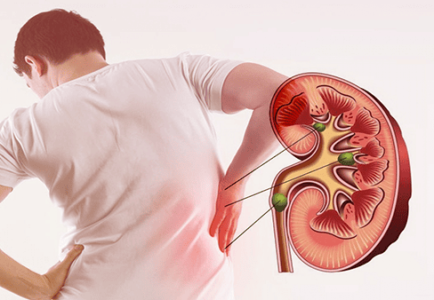 Quy trình khám sỏi thận, tiết niệu tại Thu Cúc Thụy Khuê