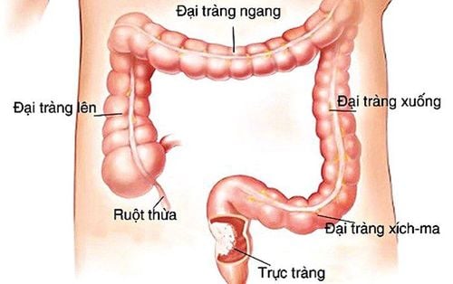 Quy trình khám và điều trị trĩ tại Thu Cúc Thụy Khuê