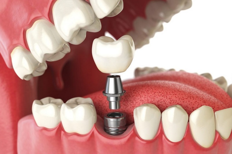 Niềng răng và trồng Implant – xu hướng chăm sóc răng hiện đại