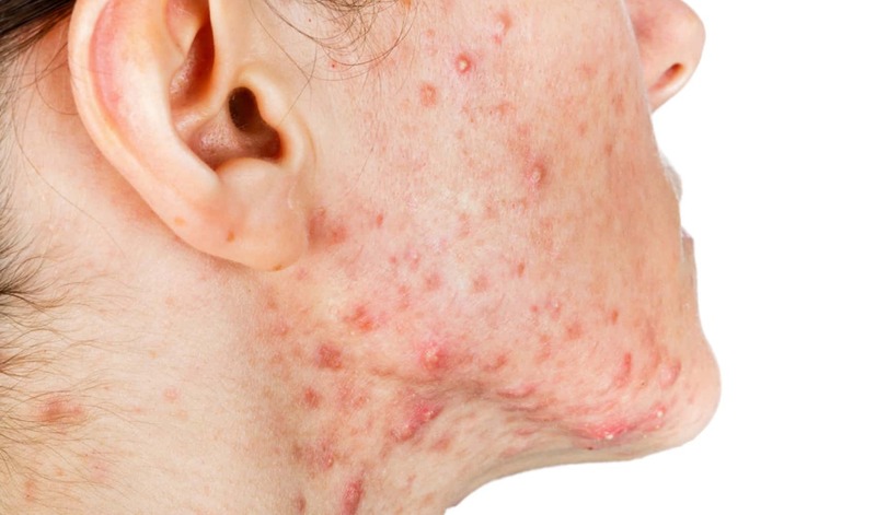 Ưu điểm của Medlatec Duy Tân trong điều trị mụn và nám