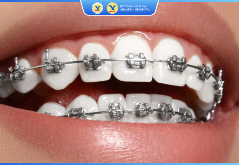 Tầm quan trọng của nội soi trong chẩn đoán và điều trị bệnh lý dạ dày