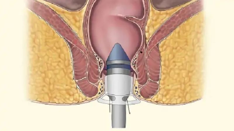 Tổng quan về bệnh trĩ