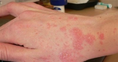 Tầm quan trọng của nội soi trong chẩn đoán và điều trị bệnh lý dạ dày