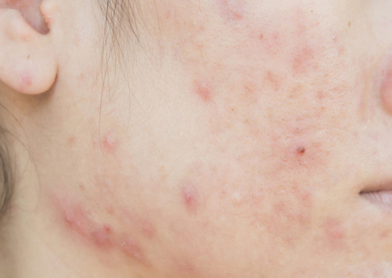 Điều trị nám và tăng sắc tố tại Medlatec Thanh Xuân