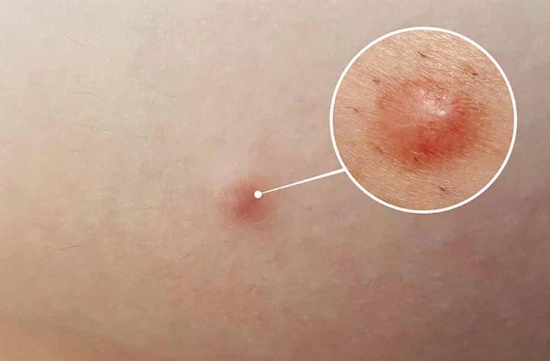 Vì sao điều trị mụn, nám cần đến cơ sở da liễu uy tín?