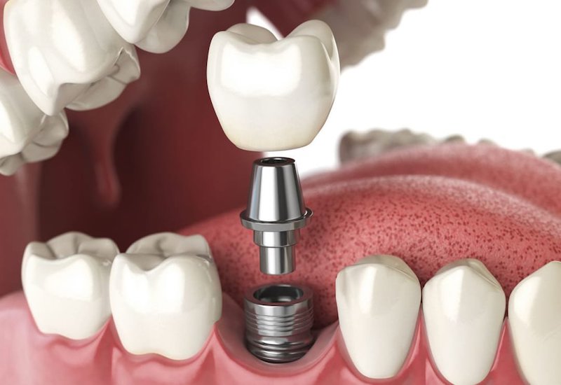 Trồng Implant tại Medlatec Thanh Xuân – Giải pháp phục hồi răng mất bền vững