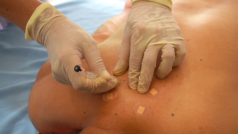 Thoát vị đĩa đệm và đau lưng: Vì sao cần chữa sớm?