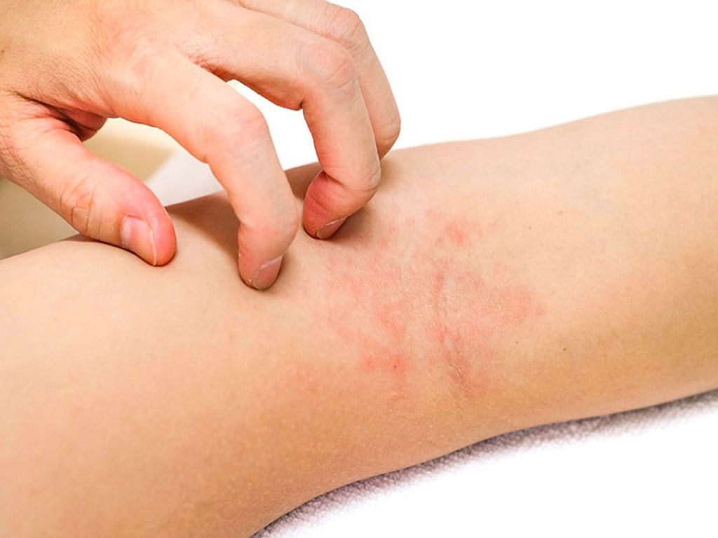 Quy trình khám và chữa viêm da cơ địa tại Medlatec Trích Sài