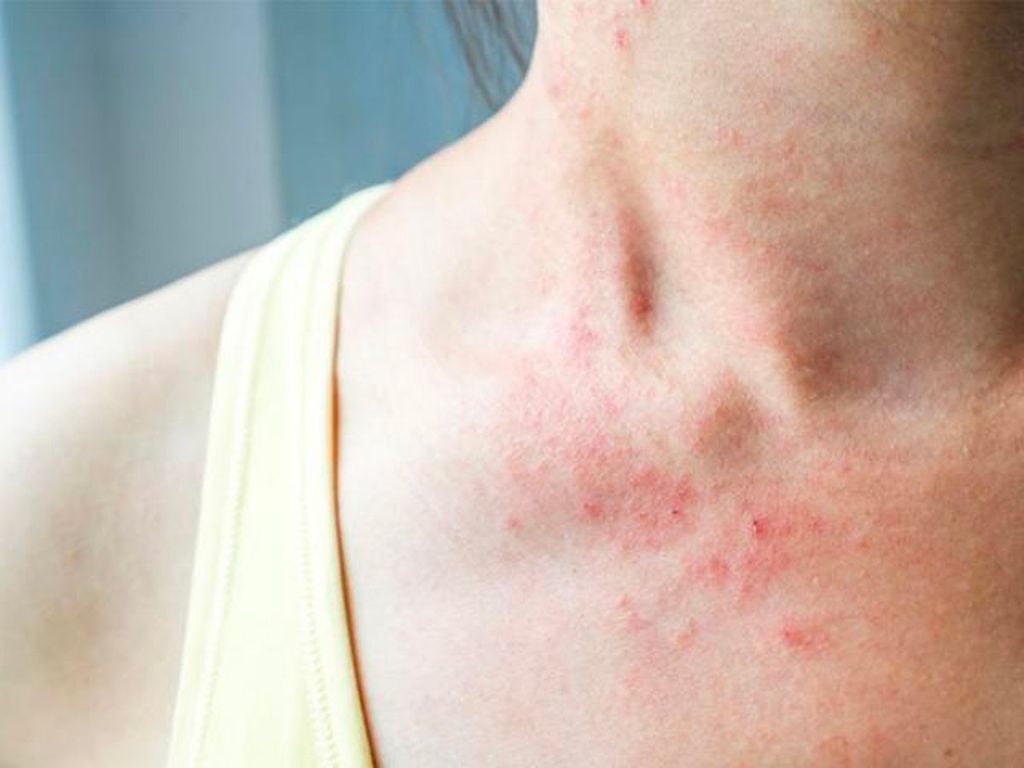 Tổng quan về viêm da cơ địa và nhu cầu điều trị tại Hà Nội