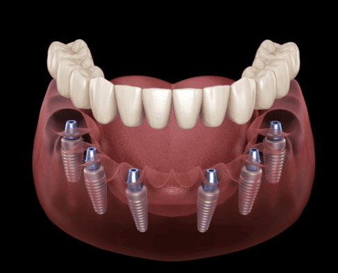 Cấy ghép Implant không đau là gì?