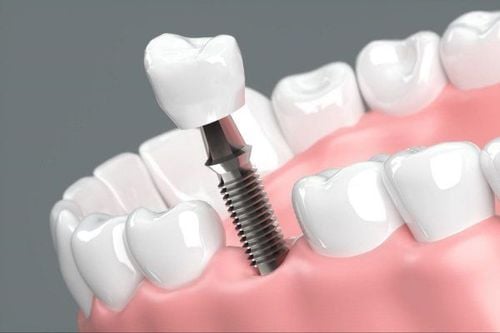 Chăm sóc sau cấy ghép Implant để hạn chế đau và biến chứng