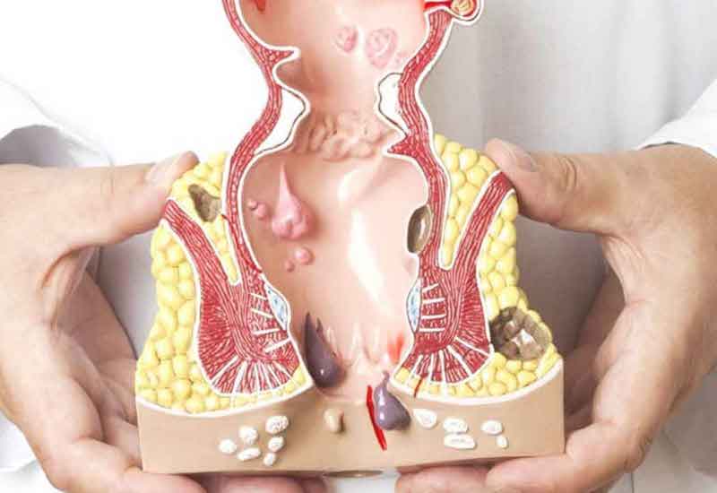 Bệnh trĩ là gì và vì sao ngày càng phổ biến