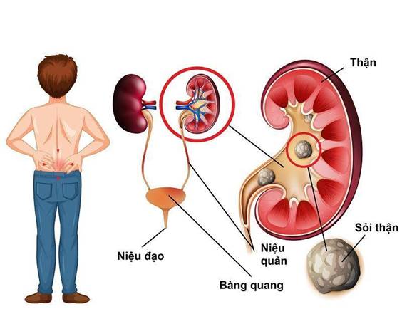 Tổng quan về bệnh sỏi thận và sỏi tiết niệu