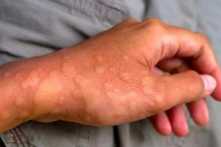 Da nổi mẩn, ngứa k&eacute;o d&agrave;i l&agrave; g&igrave;?