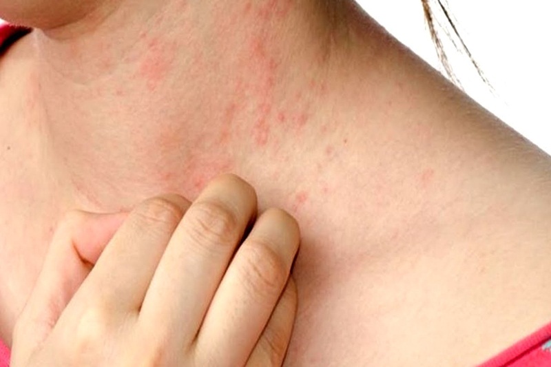 C&aacute;c dấu hiệu nhận biết da nổi mẩn, ngứa do bệnh da liễu