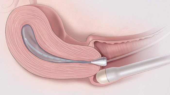 Quy tr&igrave;nh thực hiện si&ecirc;u &acirc;m đầu d&ograve;