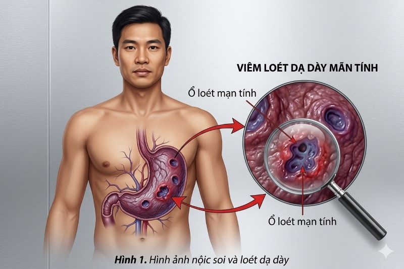 Viêm loét dạ dày tái phát nhiều lần: Vì sao lại xảy ra?