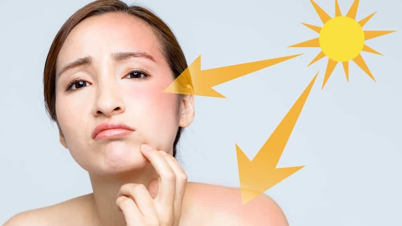 Cách phục hồi làn da sau rám nắng mùa hè hiệu quả và an toàn