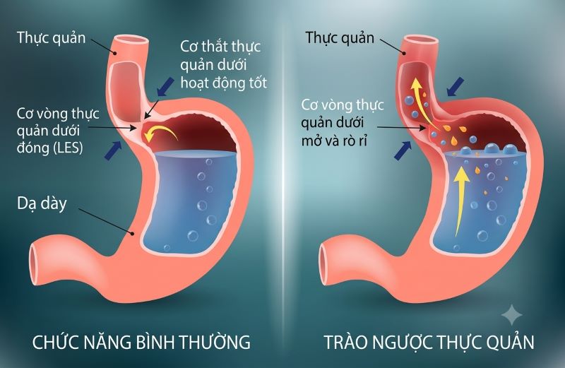 Trào Ngược Dạ Dày Thực Quản: Dấu Hiệu Cảnh Báo Và Khi Nào Cần Đi Khám?