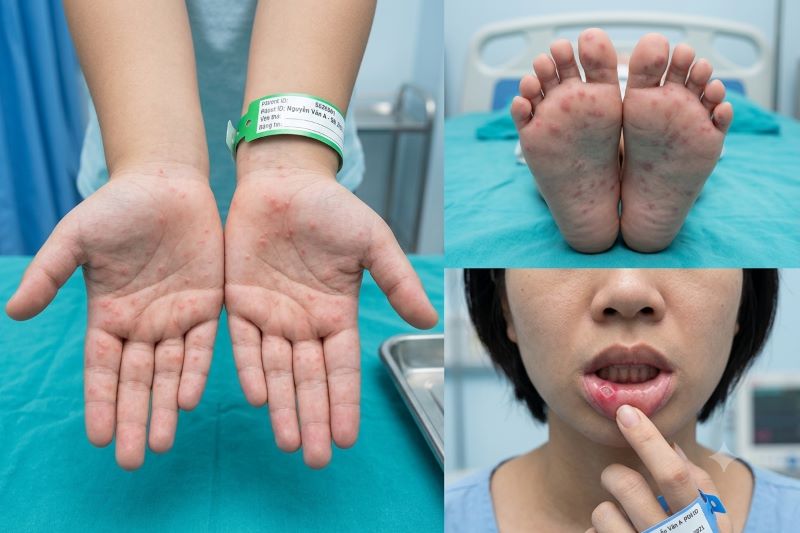 Tay Chân Miệng Ở Trẻ Em: Dấu Hiệu Nhận Biết, Cách Điều Trị Và Phòng Ngừa Hiệu Quả