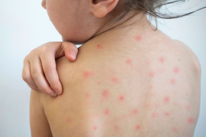 15 bệnh mùa hè thường gặp ở trẻ em: Dấu hiệu nhận biết và cách phòng ngừa cha mẹ cần biết