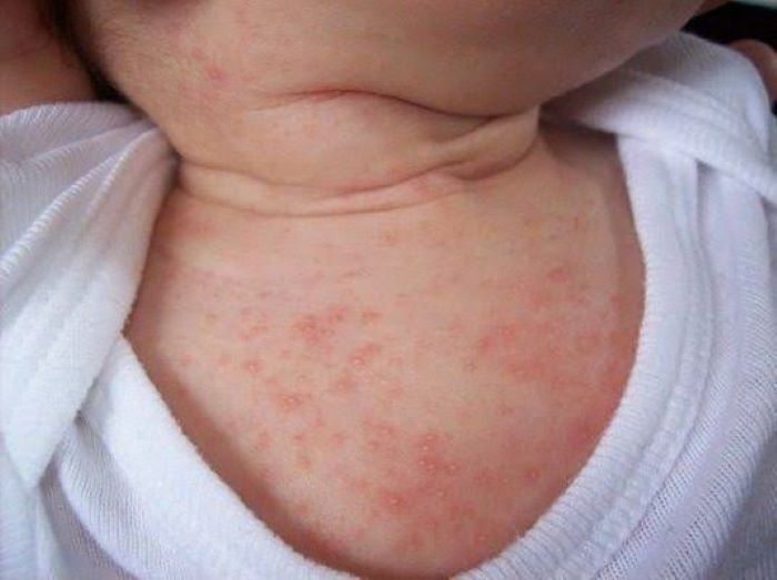 Rôm sảy: Nguyên nhân, triệu chứng, cách chẩn đoán và điều trị hiệu quả
